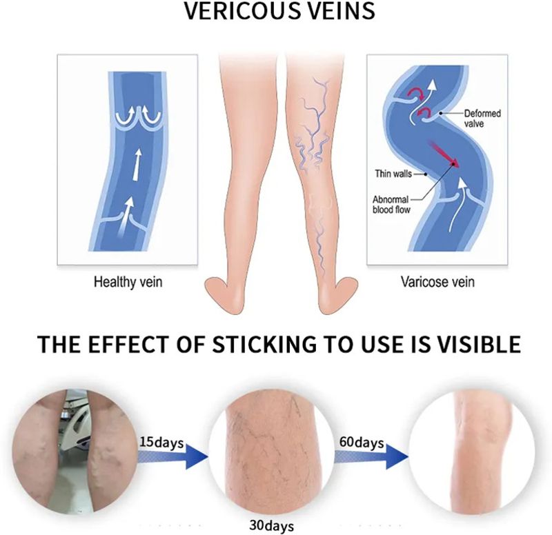 🔥HOT SALE 50% OFF🔥 Varicose Veins Patch Organic Goods